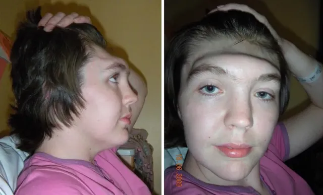 Woman-who-lost-entire-forehead-in-freak-accident-shares-transformation
