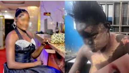 Hotel Worker Suffers Severe Burns After Allegedly Attacked with Boiling Water by Colleague's Girlfriend in Kano