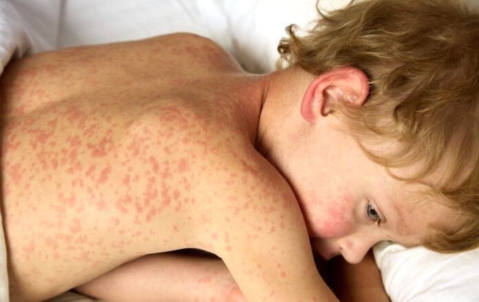 Measles Outbreak Forces UK Children to Isolate as Cases Surge in Schools