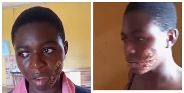 Anambra Police Arrest Guardian for Alleged Hot Iron Abuse of 17-Year-Old House Help